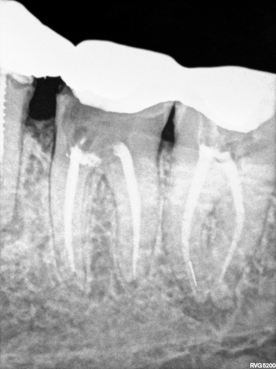 Dental X-ray
